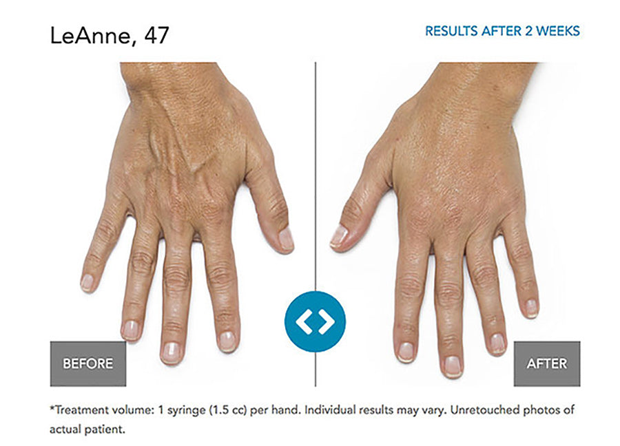 Hand Rejuvenation with Radiesse
