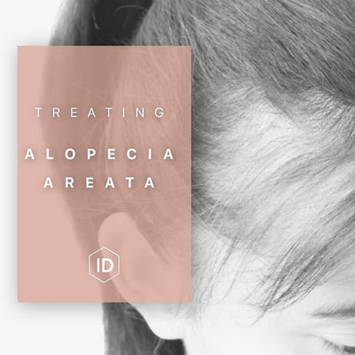 Treating Alopecia Areata