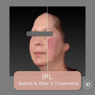 IPL before & after 4 treatments
