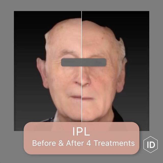 IPL before & after 4 treatments