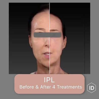 IPL: before & after 4 treatments
