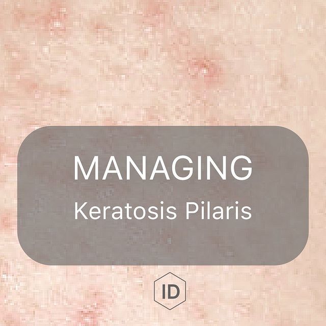 Managing Keratosis Pilaris