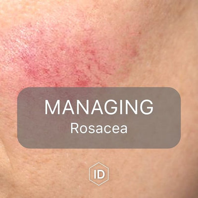 Managing rosacea