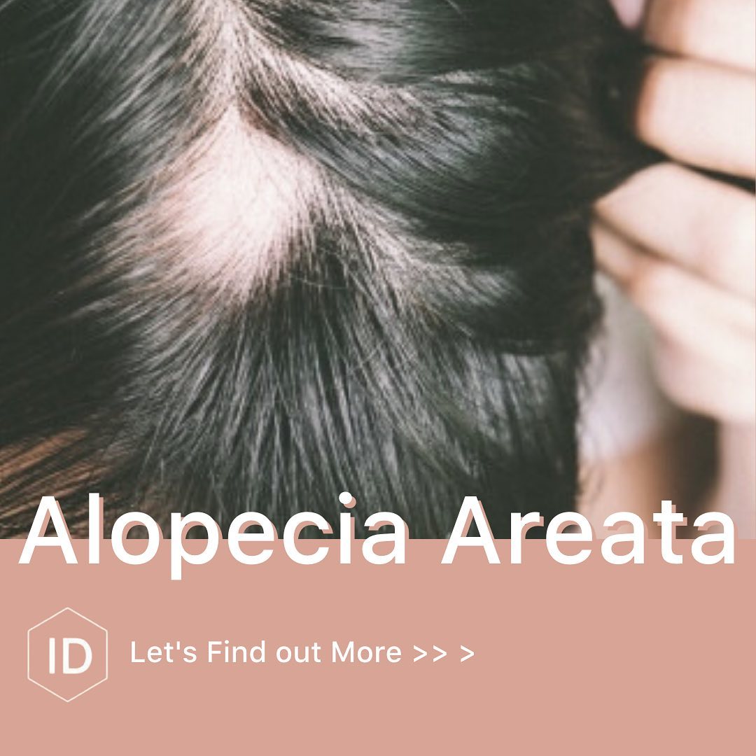 Alopecia Areata