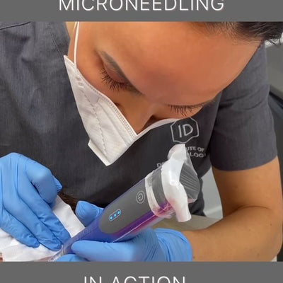 Microneedling in action