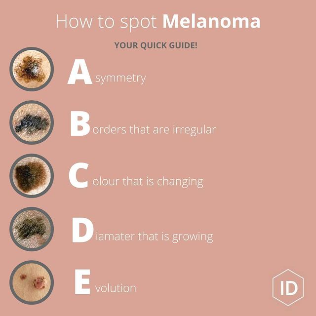 How to Spot Melanoma