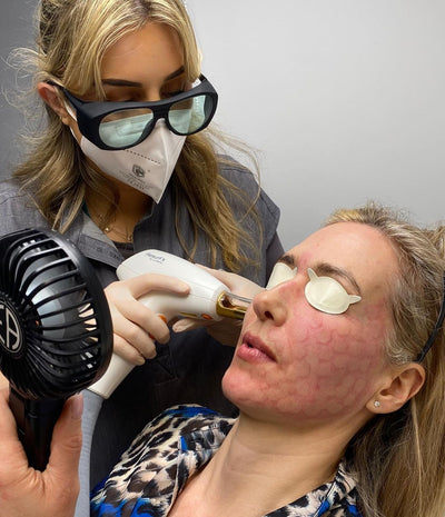 Part 2 of photofractional rejuvenation with The Fabulous pharmacist