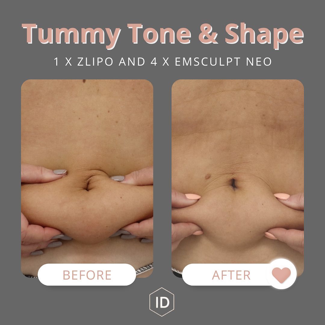 Stomach Toning Treatment Best Results NOW