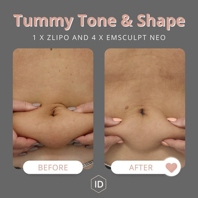 Tummy Tone and Shape Package