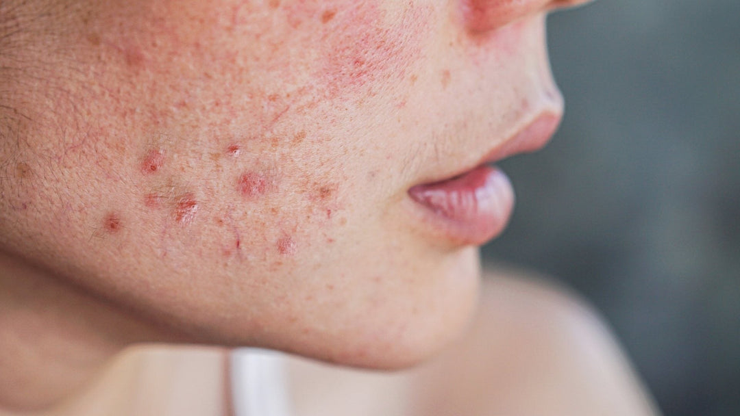 June: Acne Awareness Month