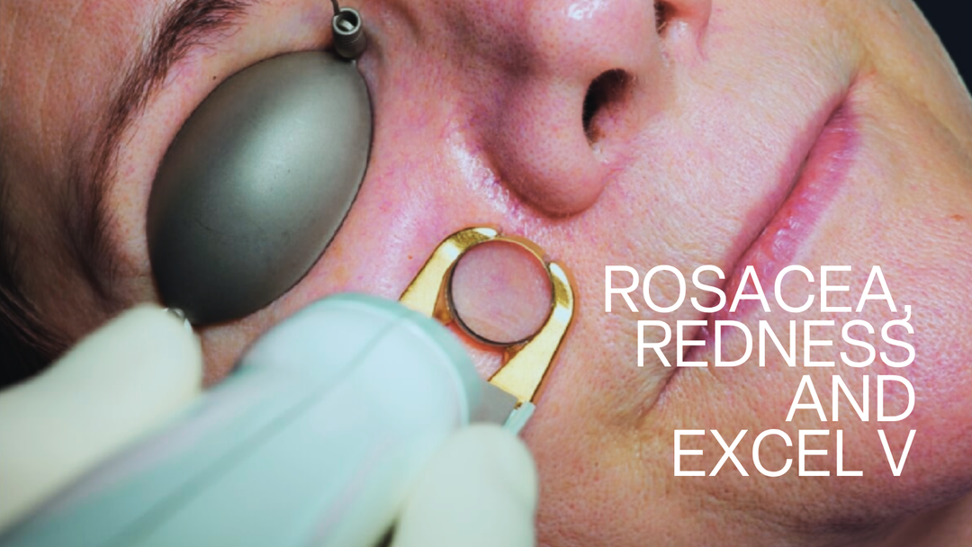 Rosacea, Redness and Excel V: A Different Approach to Laser