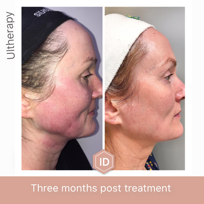 Ultherapy: 3 months post treatment