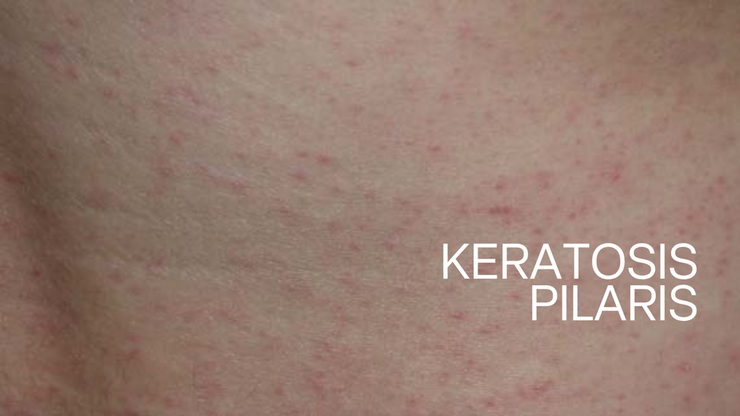 Close-up of keratosis pilaris texture on upper arm skin