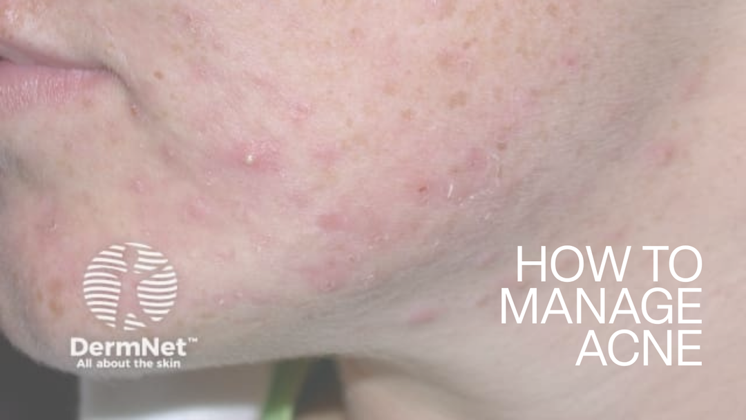 Skincare products for acne-prone skin including cleanser, moisturiser and SPF by EltaMD