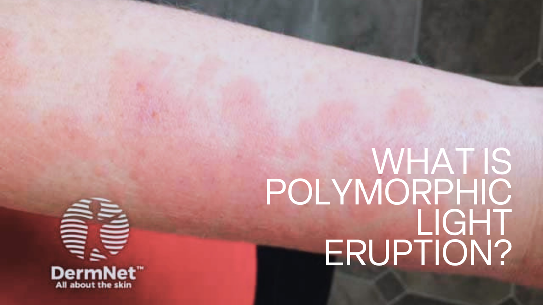 What Is Polymorphic Light Eruption? The Itchy Summer Rash Affecting 1 in 5 Irish People