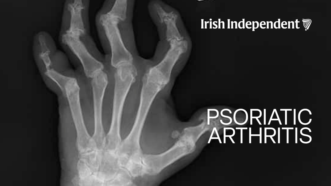 Skin Rash, Sore Joints? Professor Nicola Ralph on Psoriatic Arthritis in the Irish Independent
