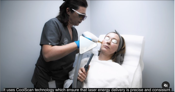 Short video on ResurFX non-ablative laser