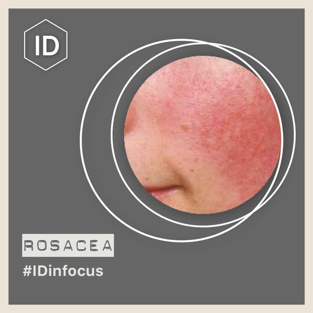 Rosacea