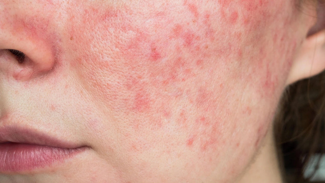 Rosacea