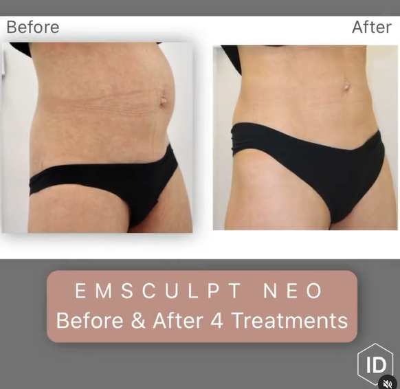 EMSCULPT NEO Before/After