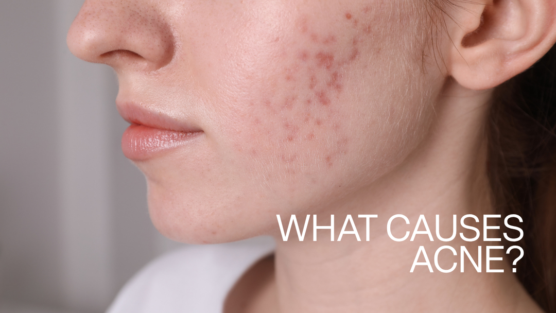 What Causes Acne? A Dermatologist’s Guide to Why Breakouts Happen