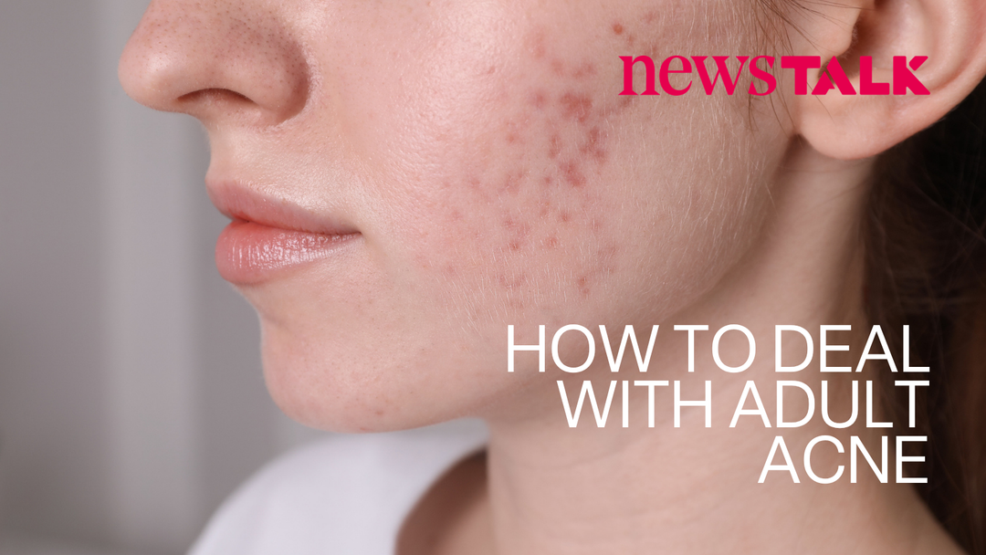 Why Do Adults Get Acne, and How Is It Treated? Professor Caitriona Ryan Explains