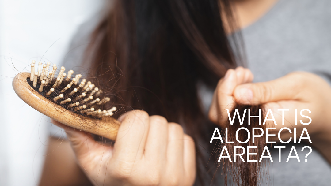 Alopecia areata causing a patch of hair loss on the scalp