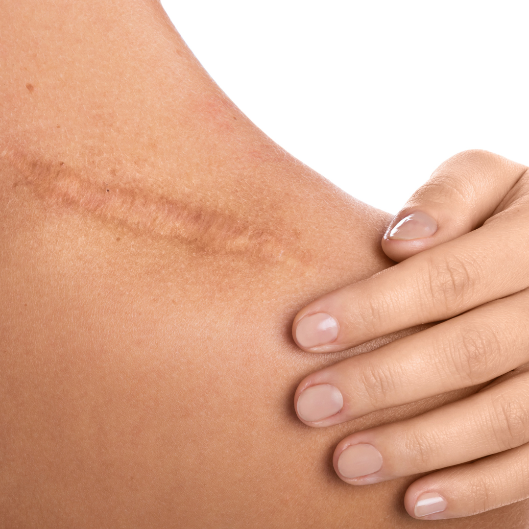 Scar Treatment