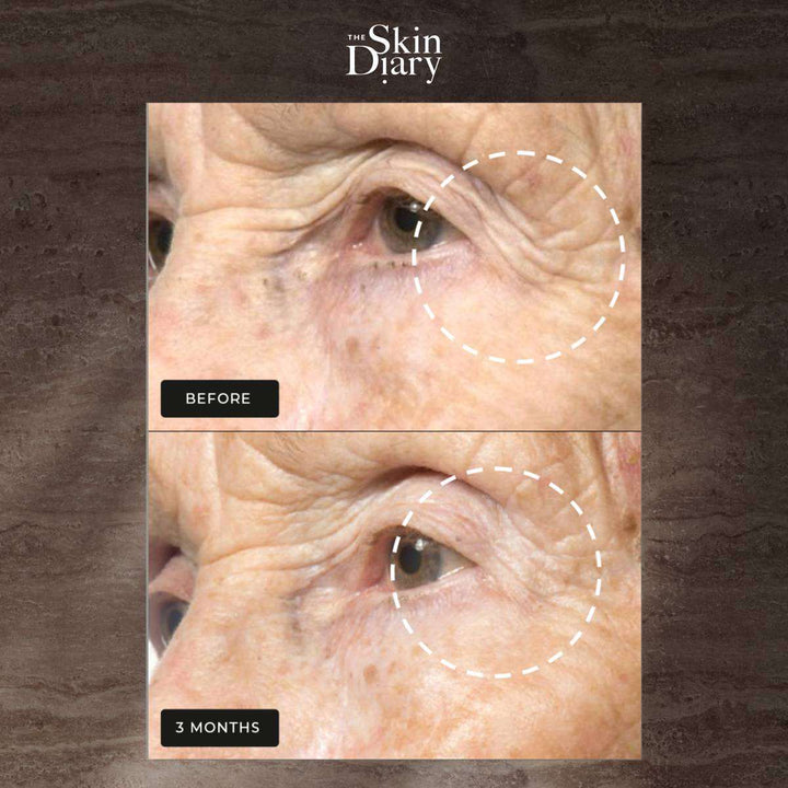 Night Repair Therapy before-and-after close-up showing reduced eye wrinkles and smoother skin after three months