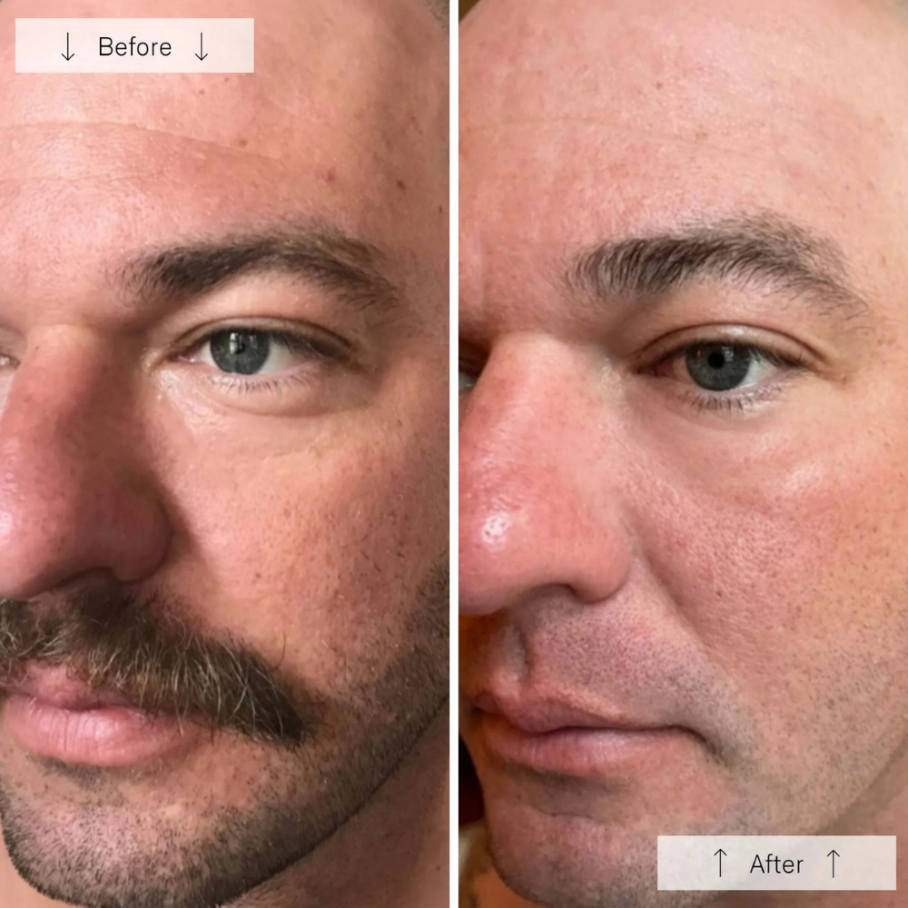 Omnilux Men LED Mask results showing male face before and after with smoother-looking skin and reduced redness