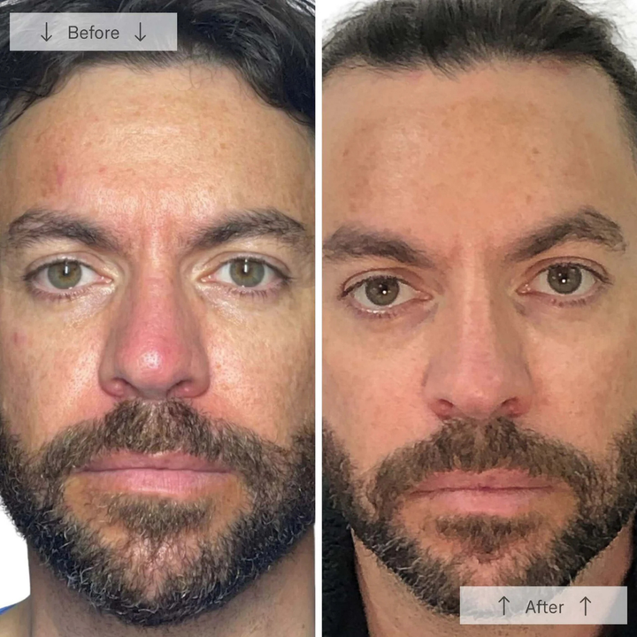 Omnilux Men LED Mask results showing a bearded man's before-and-after facial skin appearance
