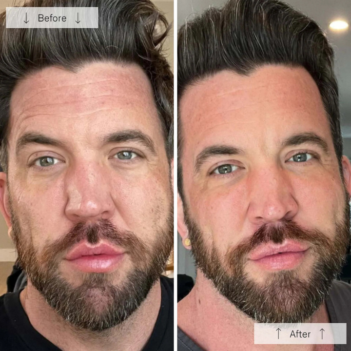 Omnilux Men LED Mask results showing a man's face before and after treatment with smoother-looking skin