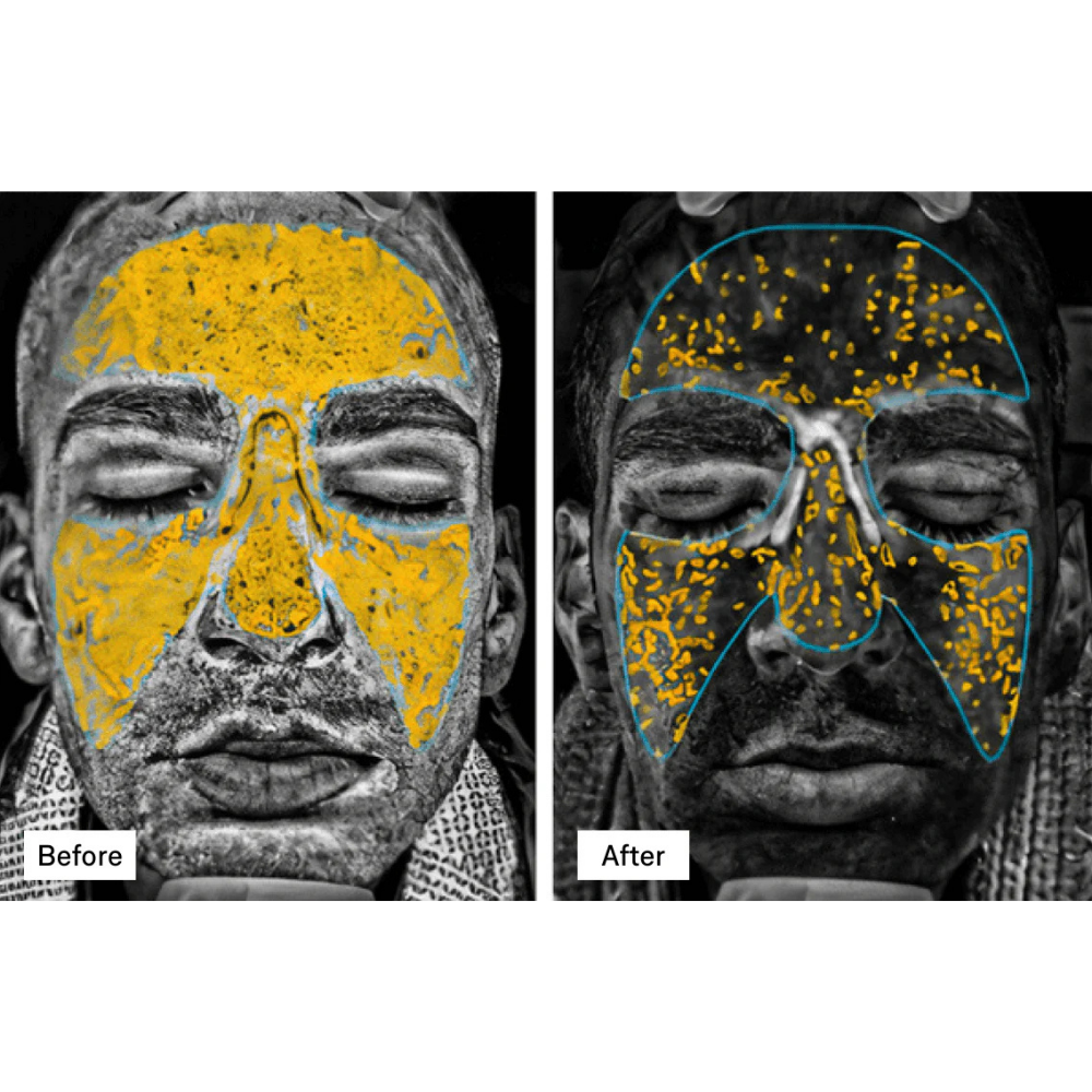 Omnilux Men LED Mask clinical before and after facial images showing reduced highlighted skin spots