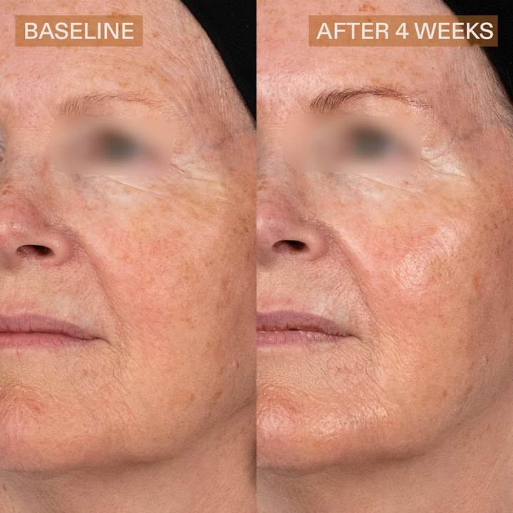 Face before and after 4 weeks of daily use of Pro Helix C. Individual results vary.