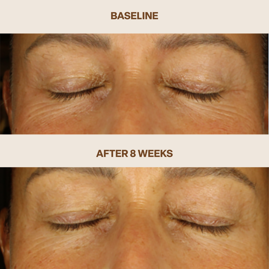 Eye area before and after 8 weeks of daily use of Pro Helix C. Individual results vary.