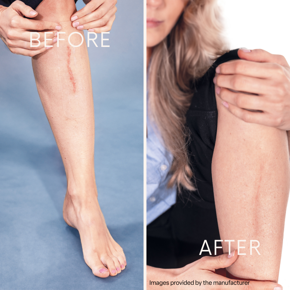 Silicone sheets shown in before-and-after scar treatment images on a leg and upper arm