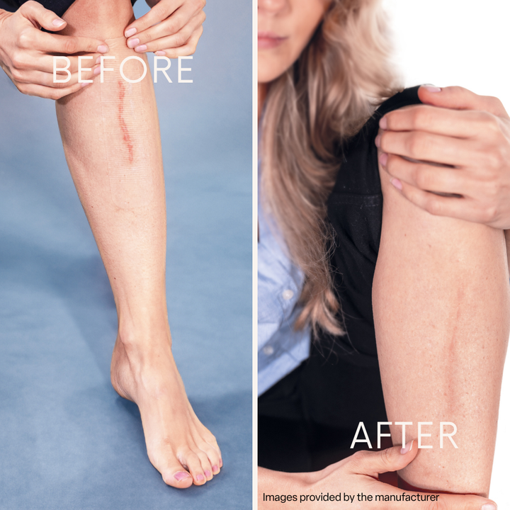 Silicone sheets shown in before-and-after scar treatment images on a leg and upper arm