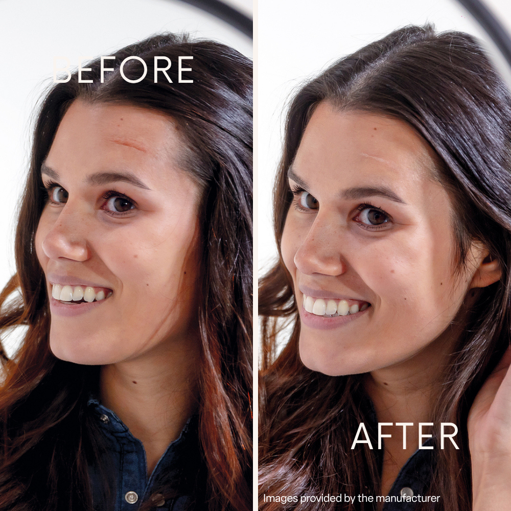 silicone sheets scar treatment shown in a before-and-after comparison of a woman's forehead scar